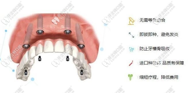 ●半口牙6個(gè)種植優(yōu)點(diǎn)一：穩(wěn)固牢靠開立特