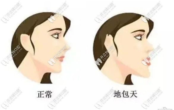 南京骨性地包天正颌手术价格