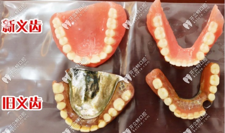 BPS吸附性義齒收費價格