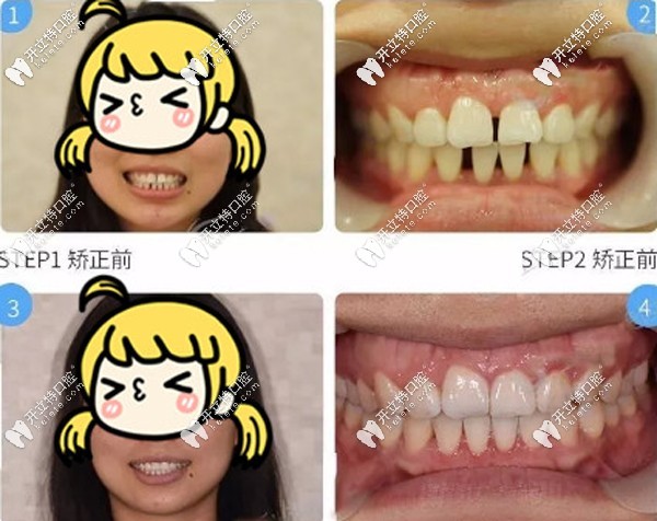 通過牙齒矯正關(guān)閉牙縫