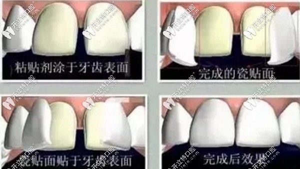 通過牙齒瓷貼面關(guān)閉牙縫
