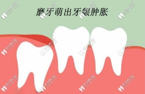 長磨牙時牙齦腫破