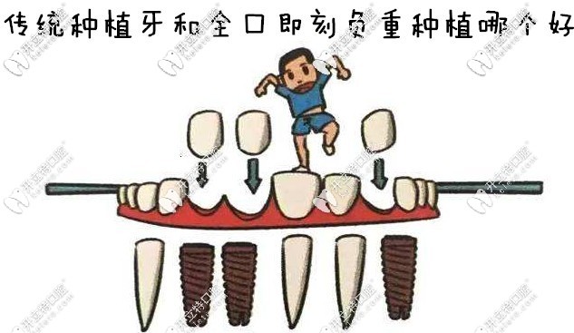 傳統(tǒng)種植牙和即刻負(fù)重種植牙哪個(gè)好？