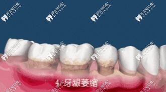 牙齦萎縮圖片