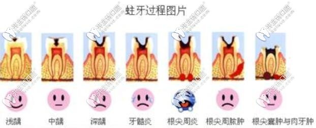 蛀牙發(fā)展過程