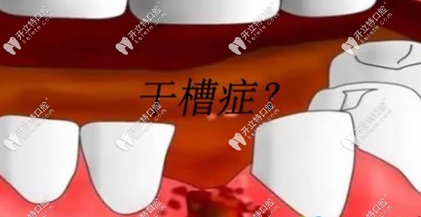 什么是牙齒干槽癥