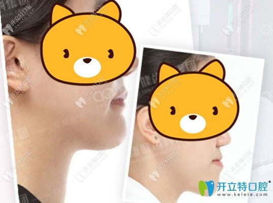 深圳愛康健隱適美隱形矯正案例效果圖展示