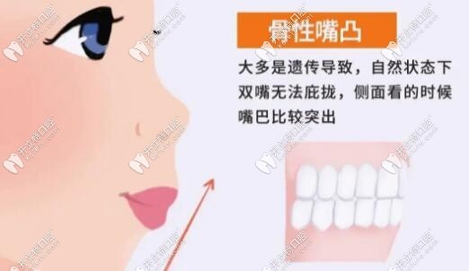 骨性凸嘴需要做正頜手術(shù)kelete.com