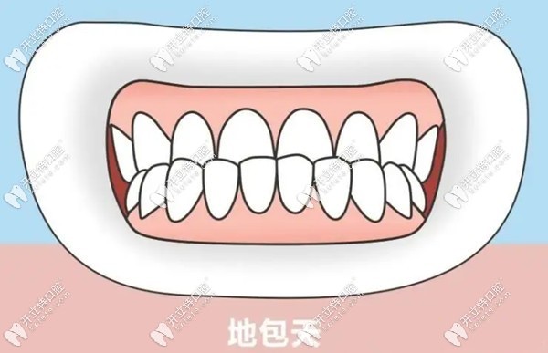 2023成都新都矯正牙齒費(fèi)用