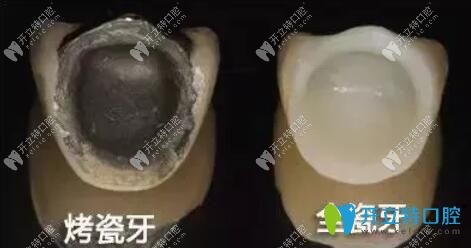 烤瓷牙與全瓷牙圖片