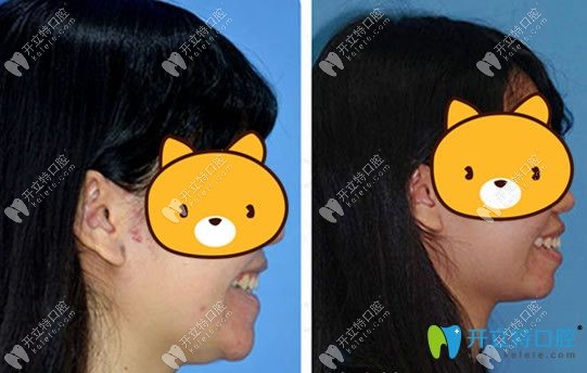 愛康健口腔齙牙隱性矯正案例前后對比效果圖
