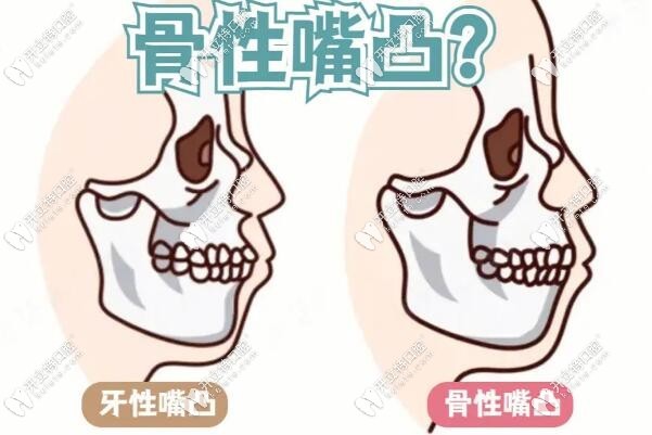 骨性凸嘴必須做正頜手術(shù)嗎？
