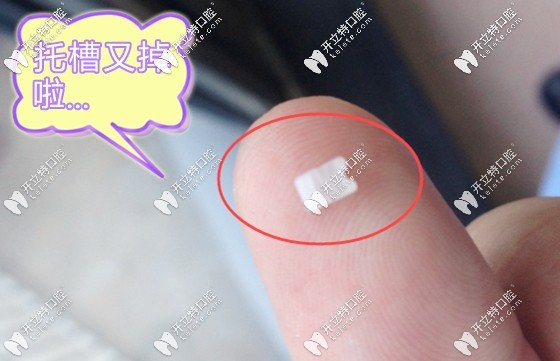 陶瓷牙套會(huì)容易脫落