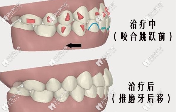 推磨牙向后的適應(yīng)癥