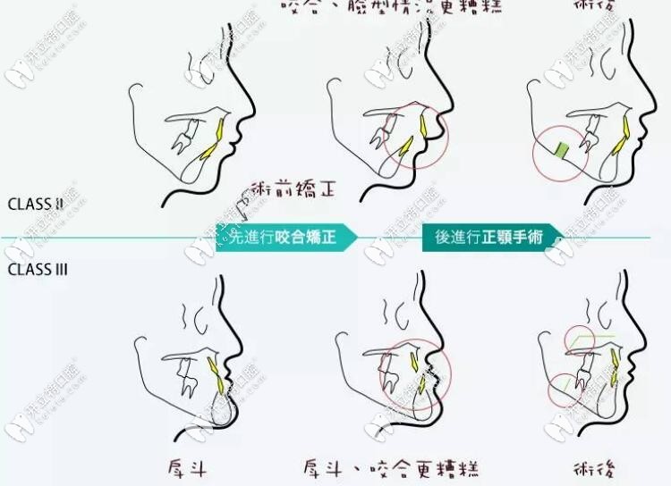 正畸正颌联合治疗术