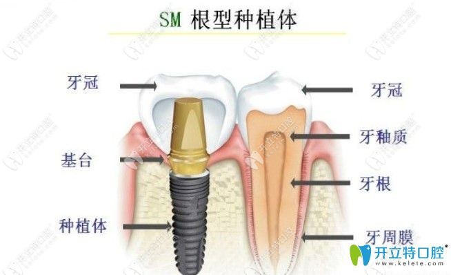 韓國dio種植體的價格