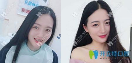 福州格莱美口腔牙齿矫正怎么样？真人钢牙矫正案例效果来证明