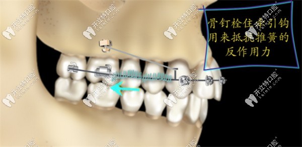 后推磨牙的矯正方法