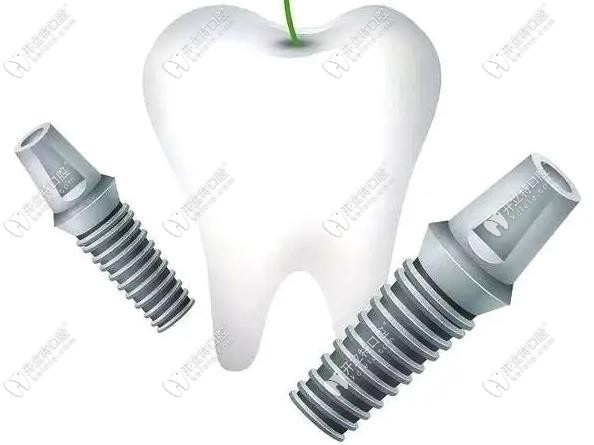 登騰種植牙價(jià)格雖便宜并不意味著品質(zhì)就不好