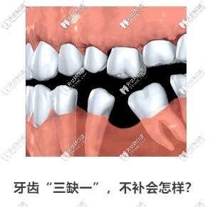 牙齿缺失不补会怎样
