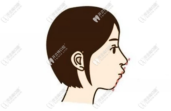 閉鎖性深覆合影響臉型