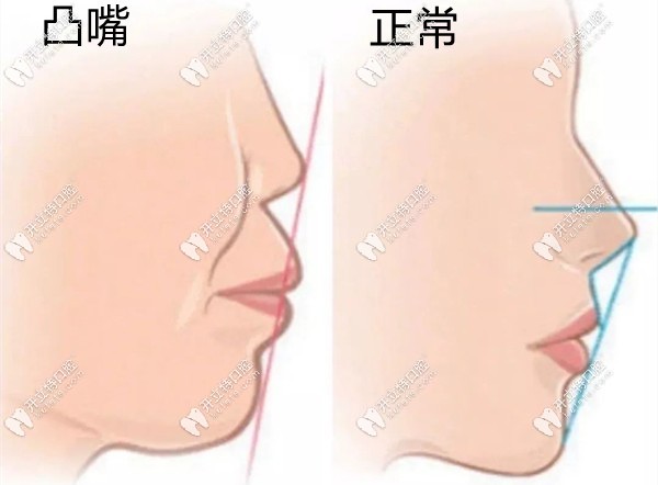 凸嘴面型和正常面型的對比