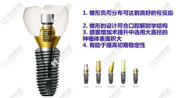 登騰種植體的優(yōu)勢(shì)
