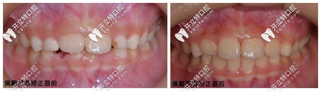 儿童矫正后的前后对比