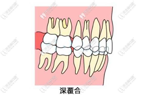 閉鎖型深覆合是骨性還是牙性