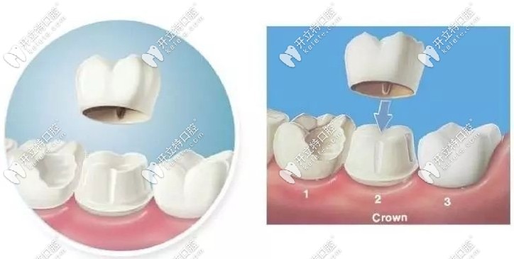 全瓷牙冠的安裝過程kelete.com