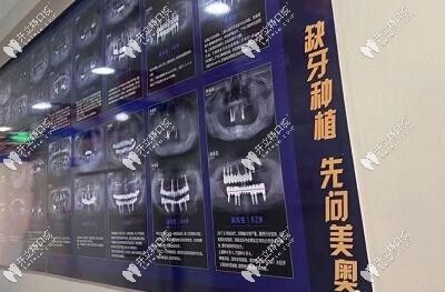 眾多種植牙病例圖展現(xiàn)