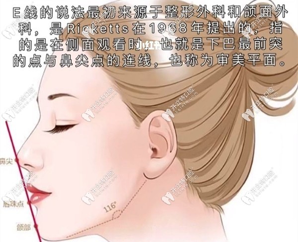 側(cè)面E線示意圖
