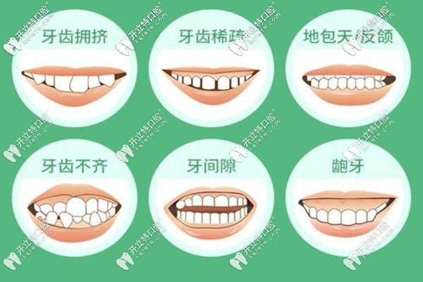 需要矯正牙齒的類型
