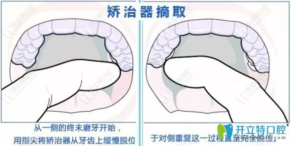 摘取隱形牙套的方法圖解