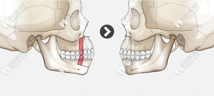 小正頜手術(shù)理解圖