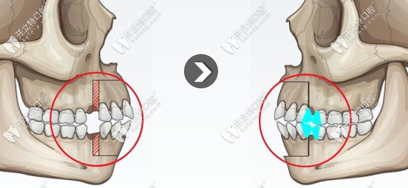 小正頜手術(shù)調(diào)整區(qū)域