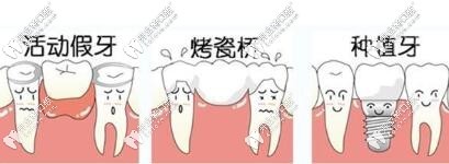 鑲牙方式有哪些