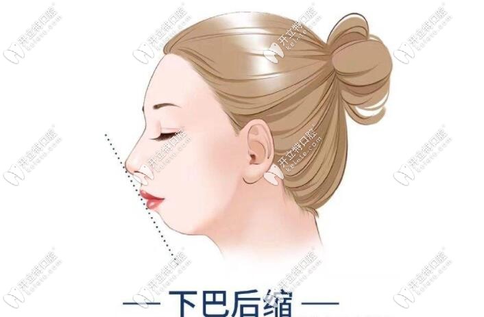 下巴后縮情況的調(diào)整