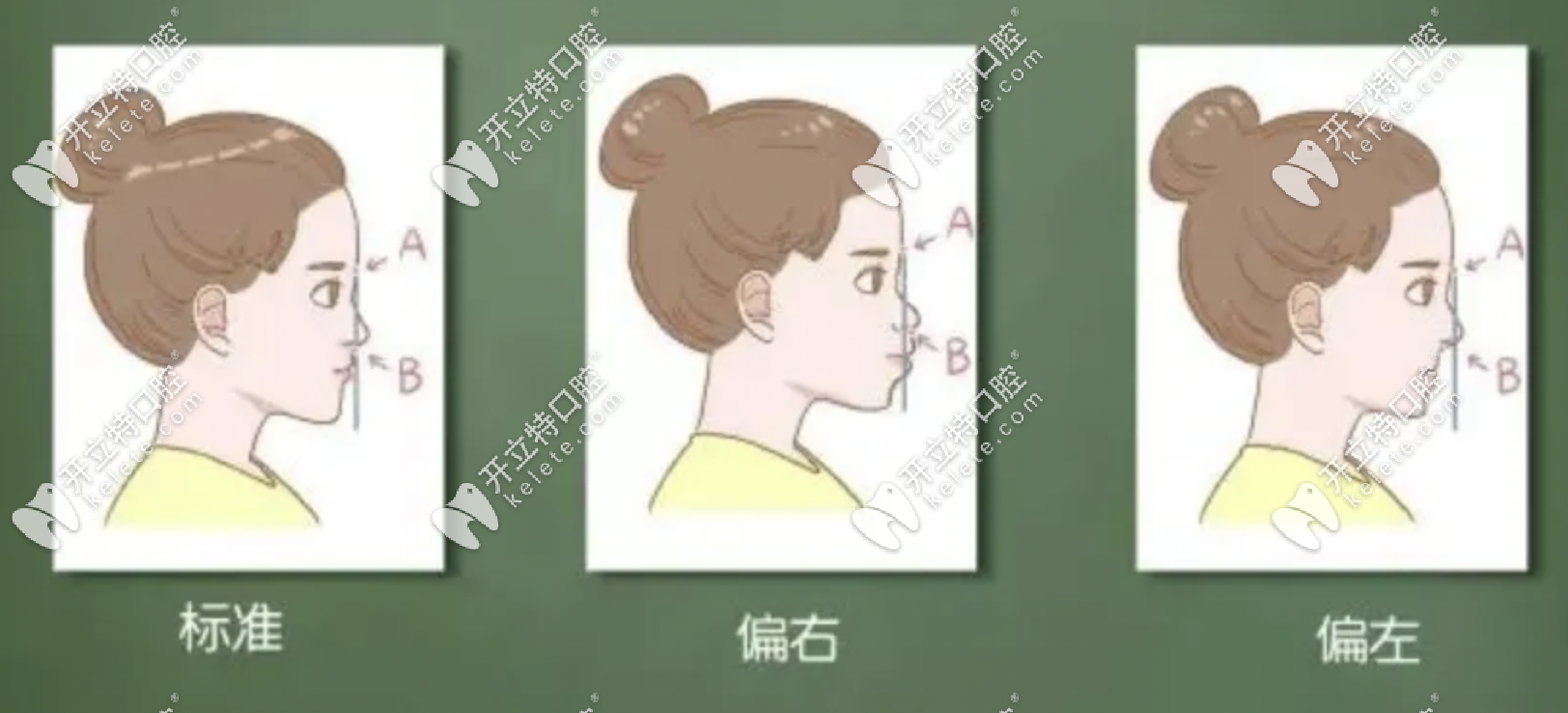 骨性龅牙内收7毫米是什么概念