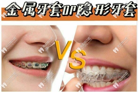 金屬牙套和隱形矯正大pk