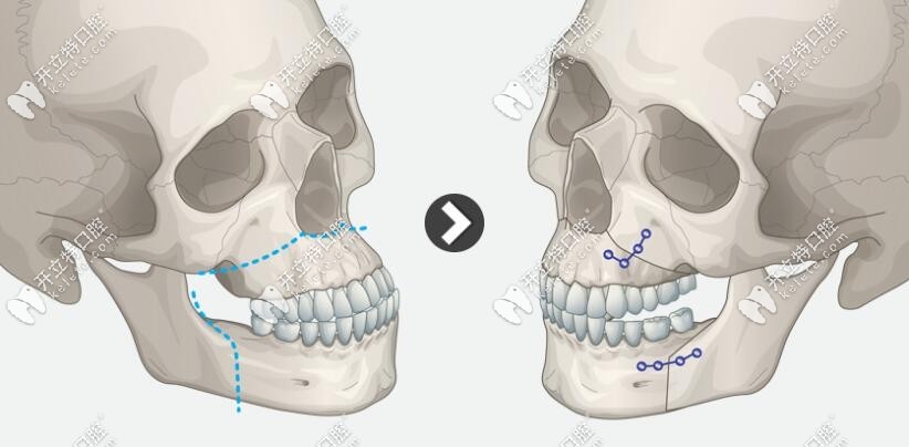 大正頜手術(shù)圖片