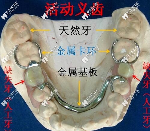 活動義齒圖片