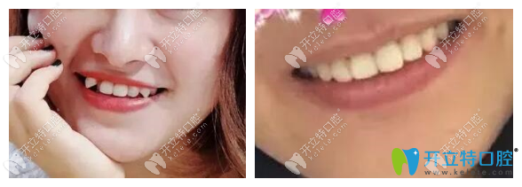 虎牙自锁托槽矫正前后照片