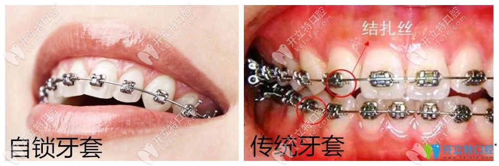 自锁和传统牙套区别图