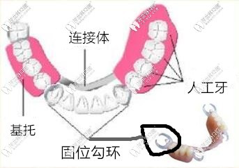 活動義齒的組成圖
