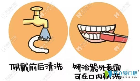 隱形牙套的清洗方法圖解