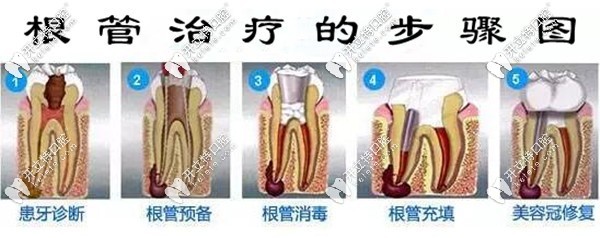根管治療步驟圖解