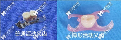 活動義齒和隱形義齒的區(qū)別