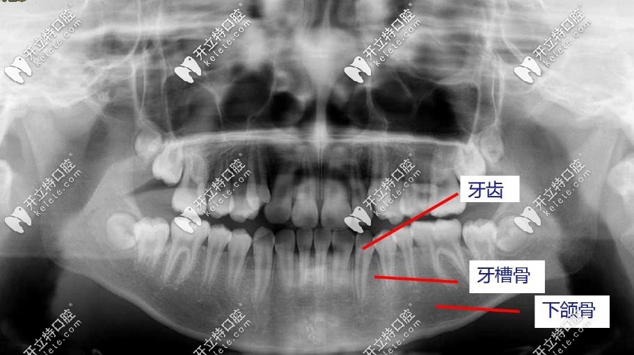 牙齿拍片的图片