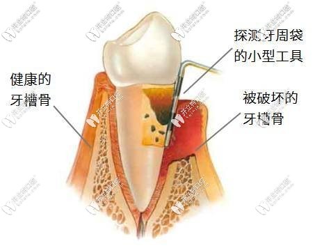 牙槽骨不足怎么办